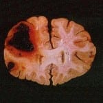 Sangramento cerebral causado por trombocitopenia